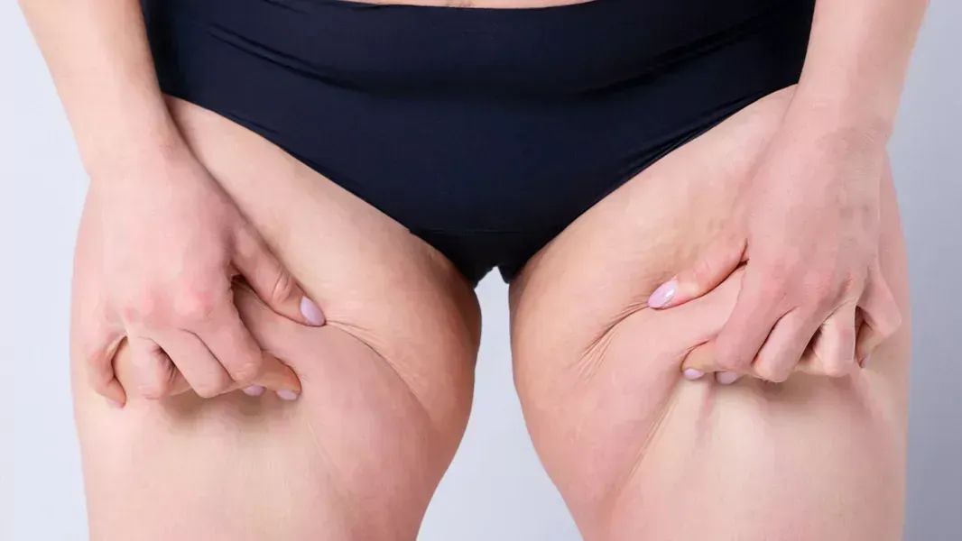 Lipedema Relief Method