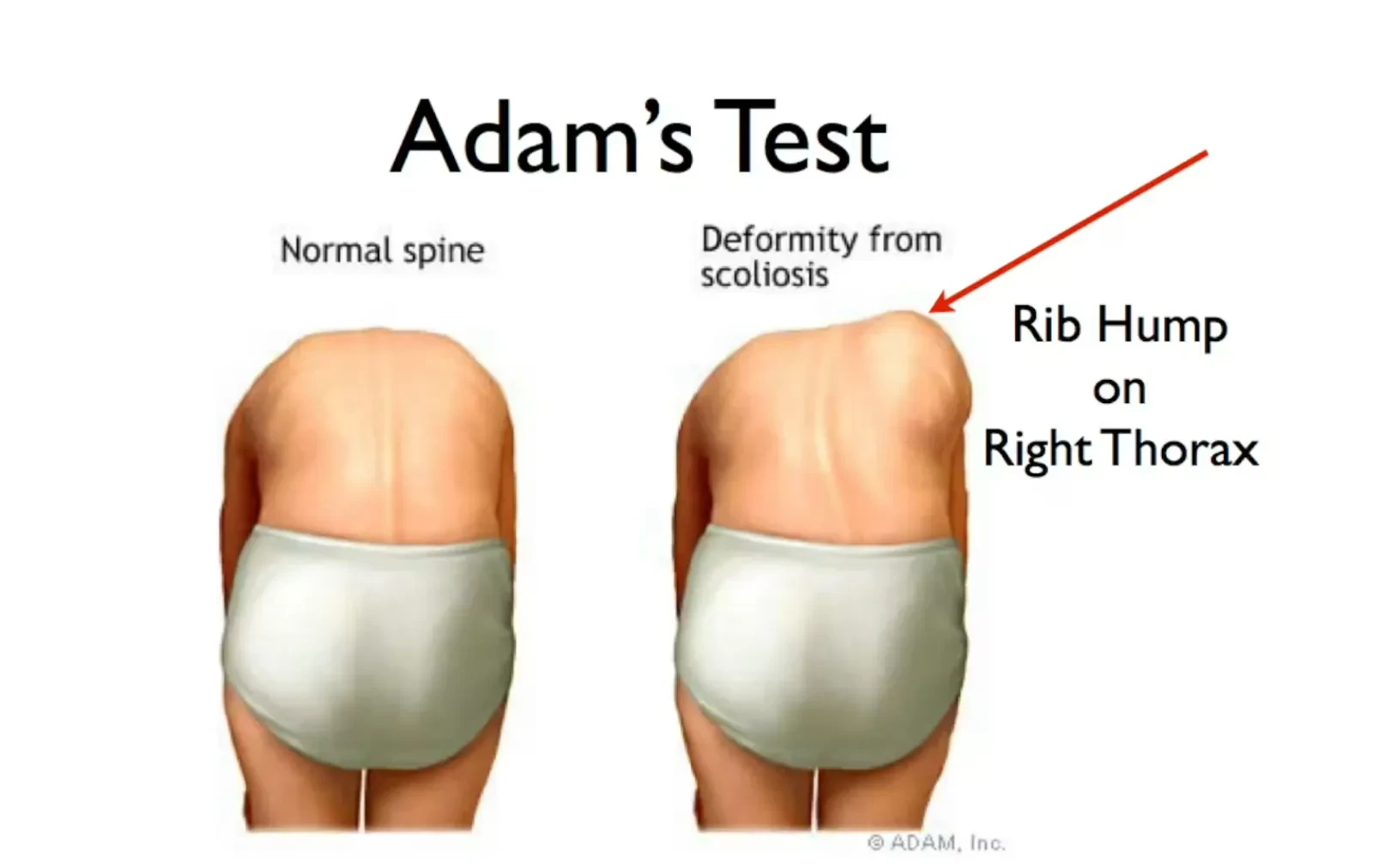 Lesson 2: What Kind Of Scoliosis Do You Have? lesson poster