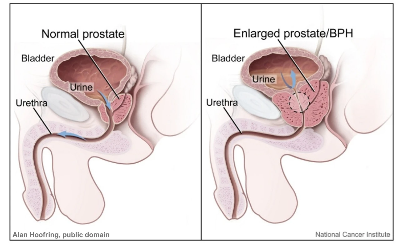 Recognizing Symptoms of BPH and Prostate Cancer lesson poster