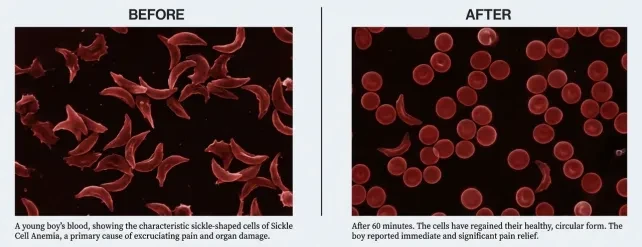 The 'Impossible' Case: Reversing Sickle Cell Anemia lesson poster